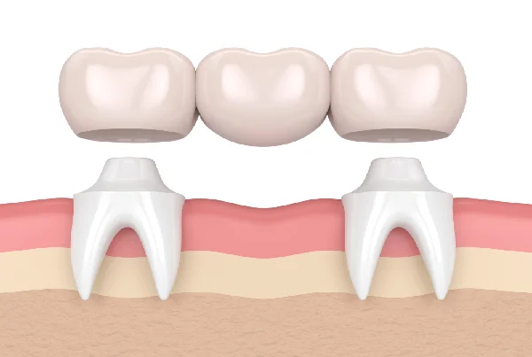 Fixed Partial Dentures